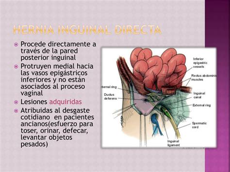 hernia inguinal derecha indirecta